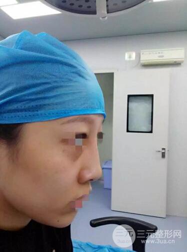 揚(yáng)州艾菲斯整形隆鼻案例，自拍盛顏不是夢！