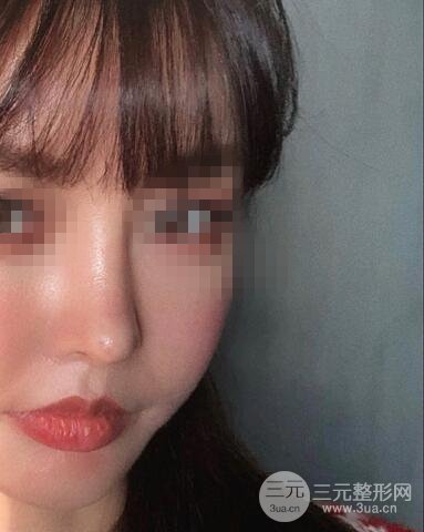 揚(yáng)州艾菲斯整形隆鼻案例，自拍盛顏不是夢！