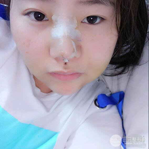 合肥壹加壹甘泉涌軟骨隆鼻前后對(duì)比圖|內(nèi)附真人案例恢復(fù)過(guò)程