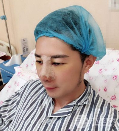 肋軟骨隆鼻整形案例分享，在深圳雅涵做的!