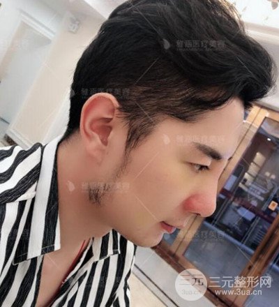 肋軟骨隆鼻整形案例分享，在深圳雅涵做的!