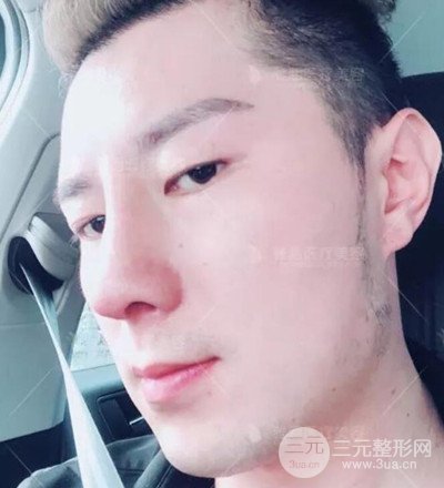 肋軟骨隆鼻整形案例分享，在深圳雅涵做的!