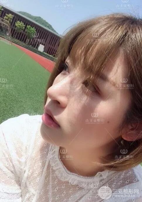 南京連天美整形周長兵隆鼻整形真人案例前后對比圖|內(nèi)附恢復過程心情日扎