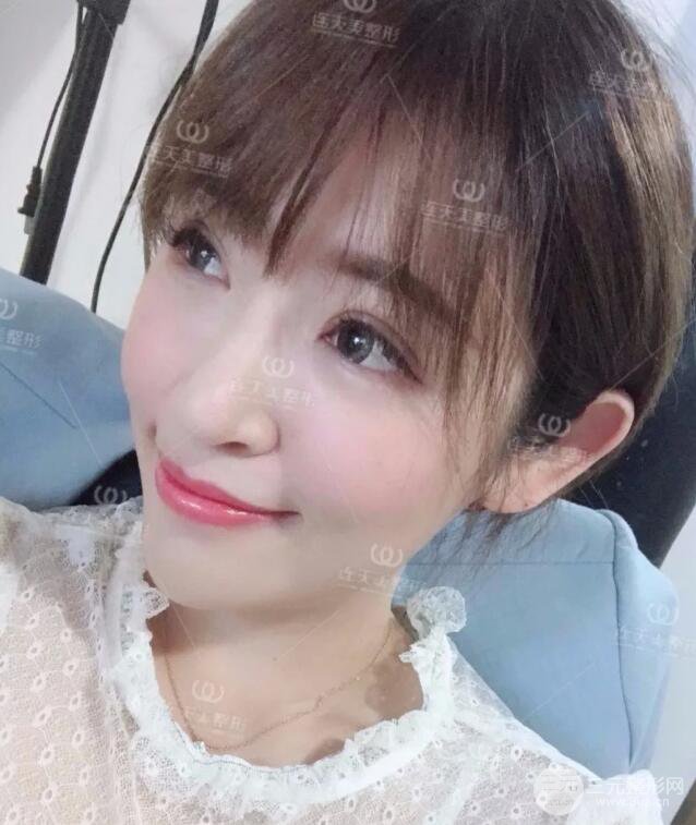 南京連天美整形周長兵隆鼻整形真人案例前后對比圖|內(nèi)附恢復過程心情日扎