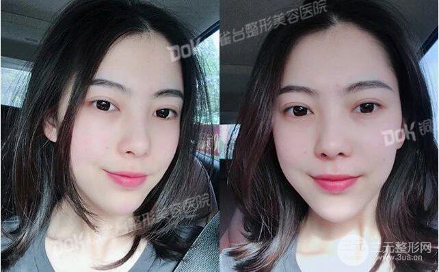 重慶銅雀臺玻尿酸注射填充案例圖片