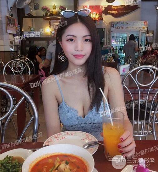 重慶銅雀臺假體隆胸案例恢復(fù)果圖