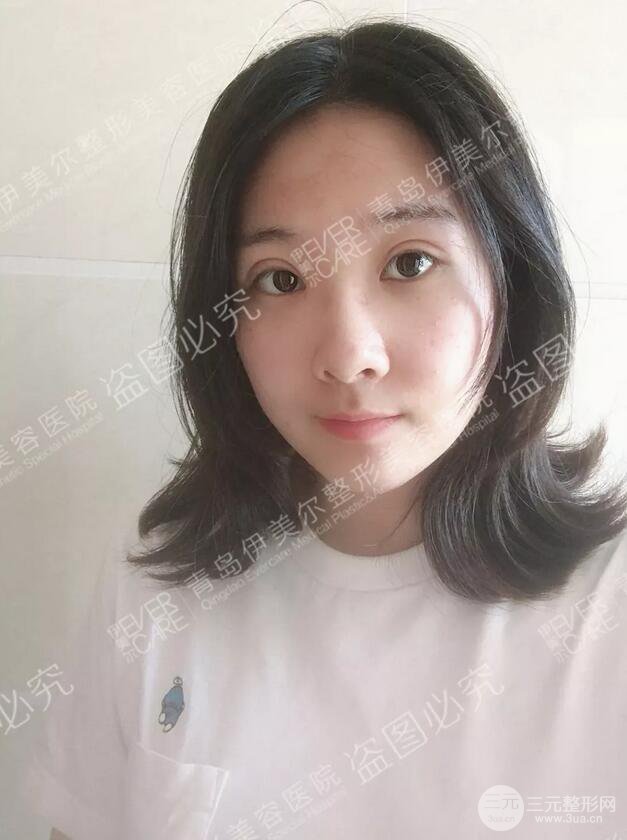 青島伊美爾雙眼皮恢復(fù)實(shí)記案例對比圖分享