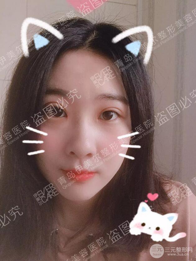 青島伊美爾雙眼皮恢復(fù)實(shí)記案例對比圖分享