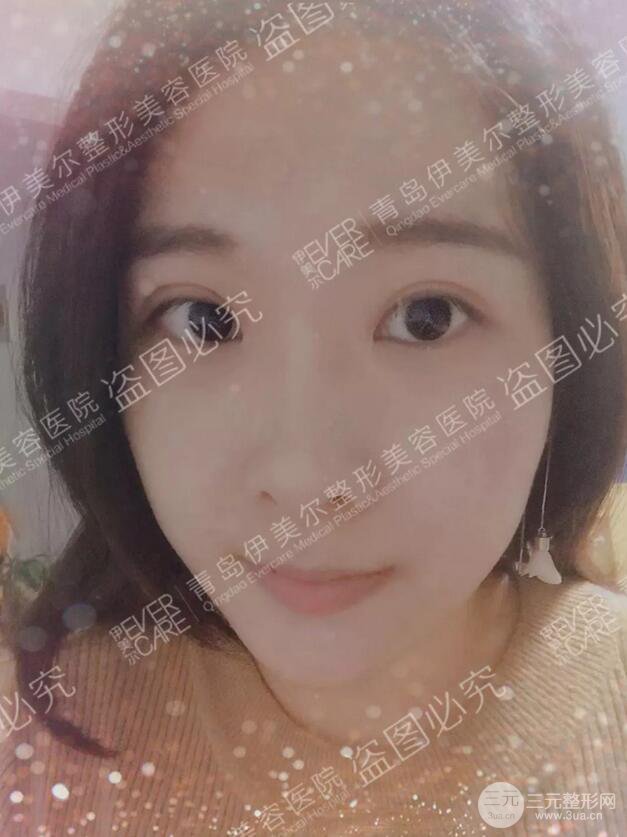 青島伊美爾雙眼皮恢復(fù)實(shí)記案例對比圖分享