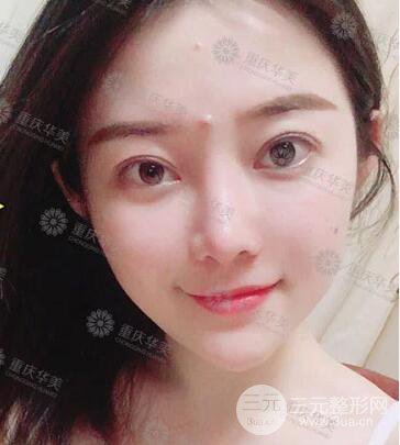 重慶華美何春濤假體隆鼻案例過程恢復(fù)分享