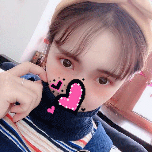 揚州艾菲斯黃嬋雙眼皮案例術(shù)后恢復(fù)果