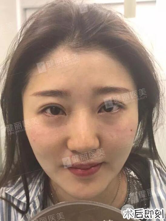 深圳健麗微創(chuàng)去眼袋+眶隔脂肪轉移術前后對比果圖分享！