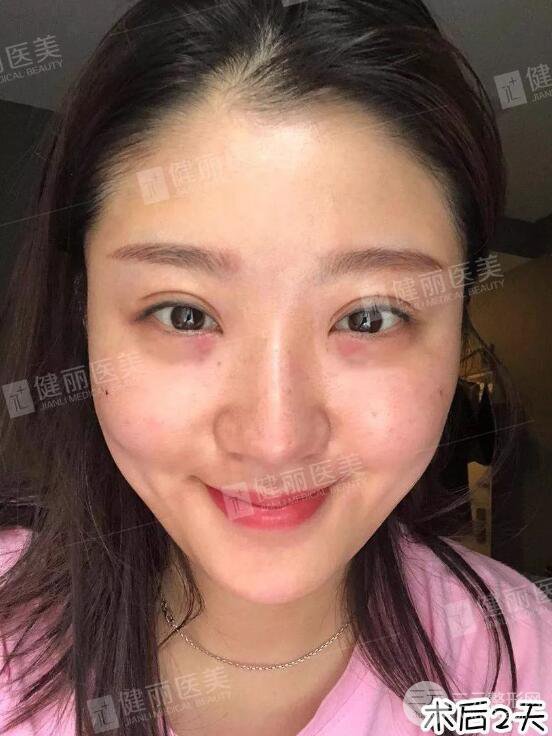 深圳健麗微創(chuàng)去眼袋+眶隔脂肪轉移術前后對比果圖分享！