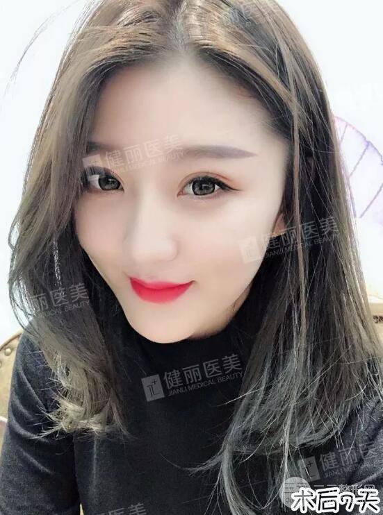 深圳健麗微創(chuàng)去眼袋+眶隔脂肪轉移術前后對比果圖分享！