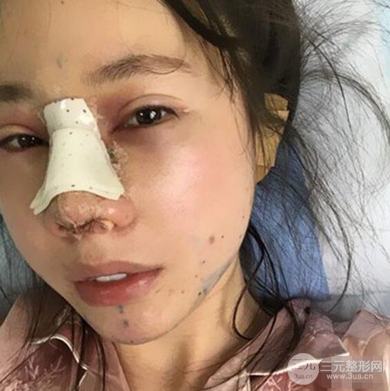 北京聯(lián)合麗格吳焱秋耳軟骨隆鼻前后對比圖|塌鼻子的救星