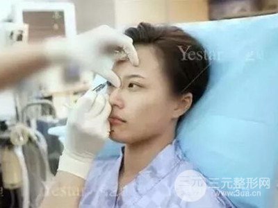 成都藝星切開雙眼皮+隆鼻整形日記分享