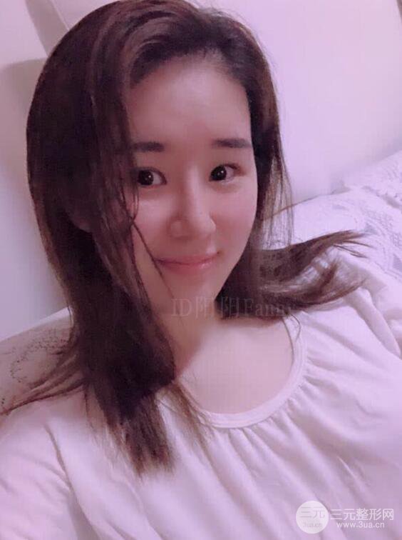 上海華美李庭勛假體隆鼻前后對比圖一個(gè)月恢復(fù)心情日記