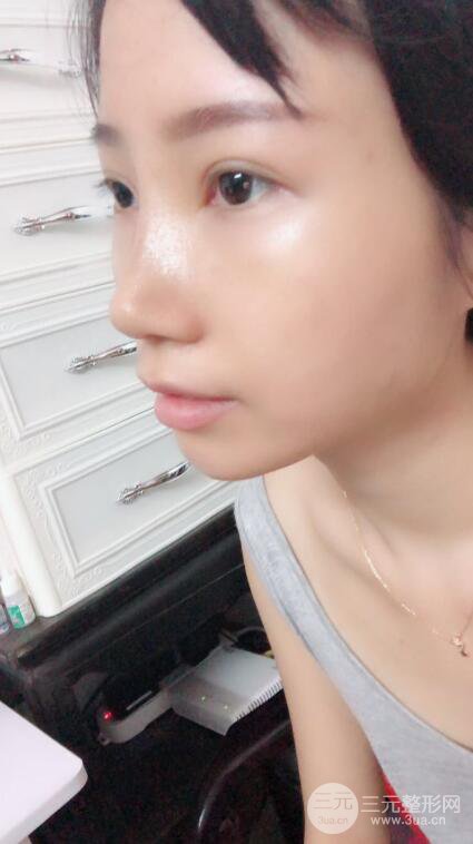 昆明華美美萊楊繼紅肋軟骨隆鼻前后對比圖恢復手札