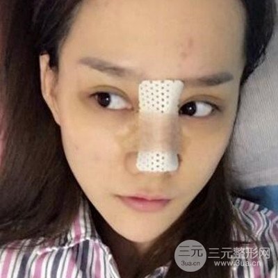 廣州韓妃李光琴隆鼻失敗修復(fù)前后對(duì)比圖分享！