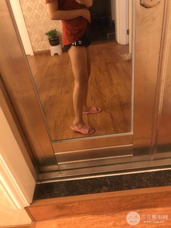 德陽東美奧克拉楊華博大腿吸脂前后對比圖 四個月恢復變化小記