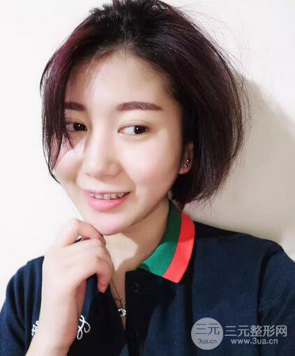 北京大學口腔醫(yī)院牙齒矯正案例詳情