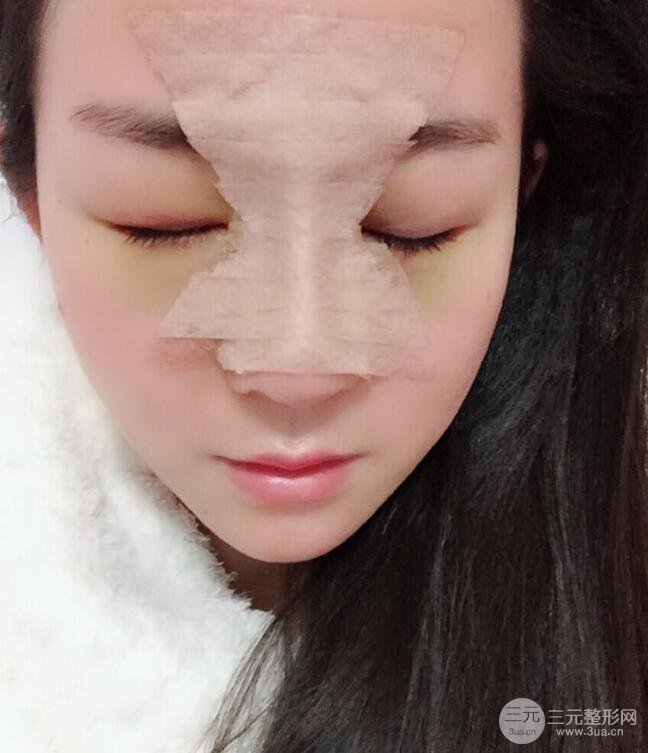 杭州華山連天美高俊明假體隆鼻術(shù)前術(shù)后對(duì)比圖 兩個(gè)月恢復(fù)心情