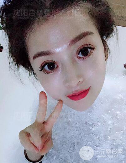 沈陽(yáng)杏林朱石江隆鼻隆鼻整形案例手術(shù)過(guò)程記錄