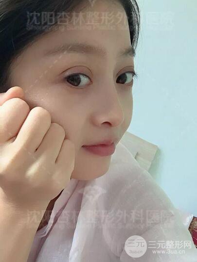 沈陽(yáng)杏林朱石江隆鼻隆鼻整形案例手術(shù)過(guò)程記錄