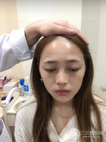 重慶愛(ài)思特整形隆鼻案例術(shù)后恢復(fù)果分享！