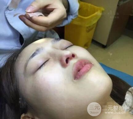 重慶愛(ài)思特整形隆鼻案例術(shù)后恢復(fù)果分享！