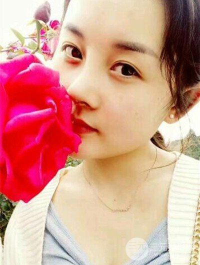 成都艾美薇魏東隆鼻整形手術前后恢復果圖分享