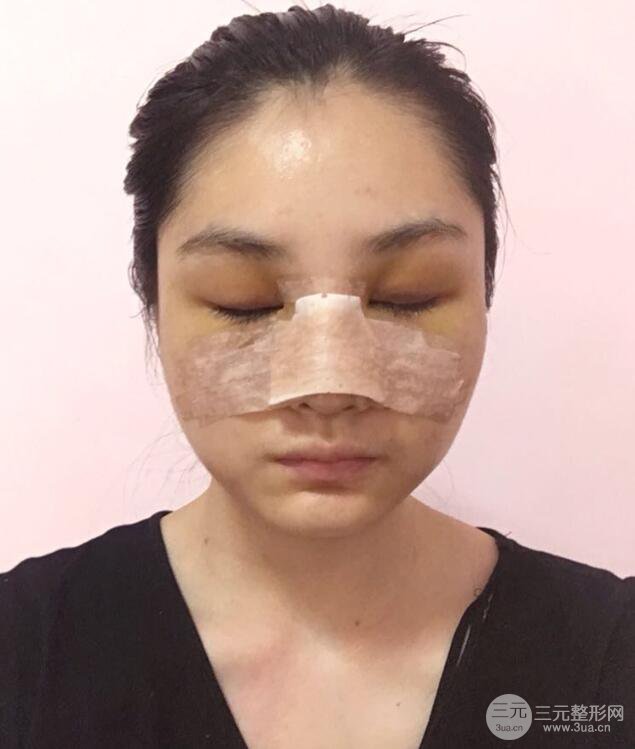 蘇州紫馨顧陸健韓式隆鼻前后對比圖|真人案例心情日記