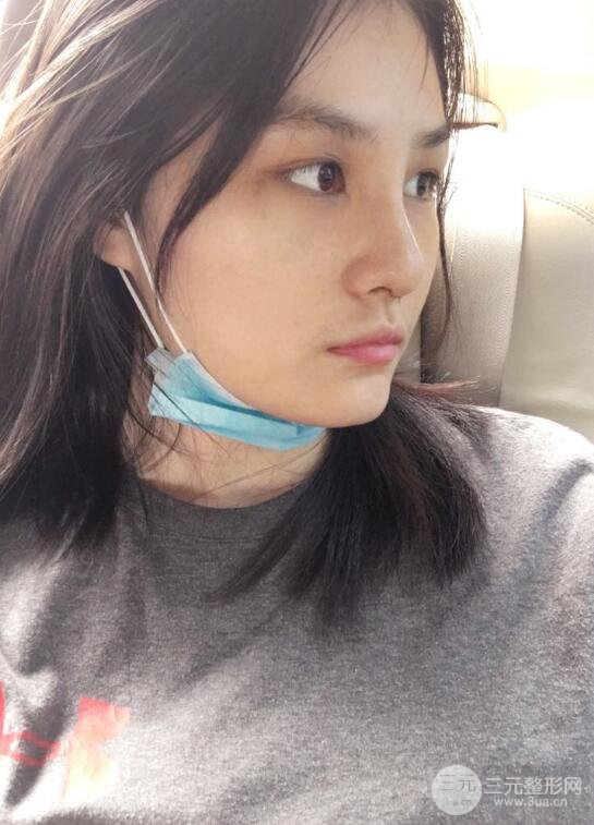 蘇州紫馨顧陸健韓式隆鼻前后對比圖|真人案例心情日記