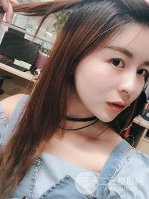 沈陽美萊高國林自體脂肪填充面部案例前后對比果圖分享