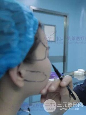 沈陽美萊高國林自體脂肪填充面部案例前后對比果圖分享