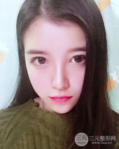 成都天使之翼金輝假體隆鼻案例前后對比圖分享~