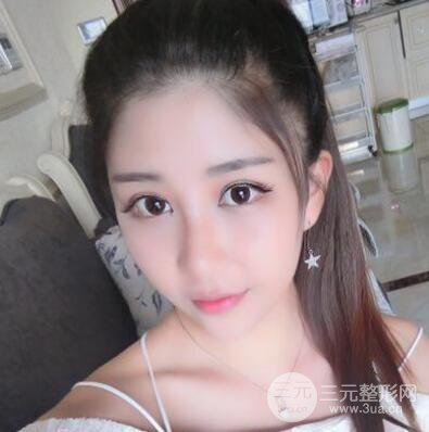 沈陽軍區(qū)總醫(yī)院時杰切開雙眼皮案例對比圖|內(nèi)附心情恢復(fù)小札哦