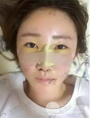 沈陽(yáng)杏林史靈芝醫(yī)生隆鼻整形案例日記分享~