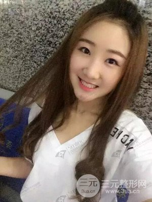 沈陽(yáng)杏林史靈芝醫(yī)生隆鼻整形案例日記分享~