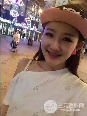 沈陽(yáng)杏林史靈芝醫(yī)生隆鼻整形案例日記分享~