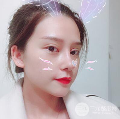 哈美萊鄭東學(xué)隆鼻整形案例對(duì)比圖真實(shí)心情分享喲~