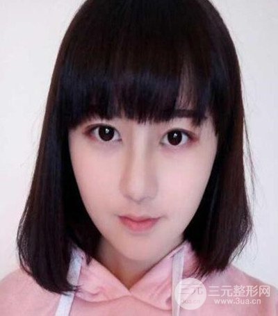 濟(jì)南韓氏郭廣科醫(yī)生隆鼻案例分享~