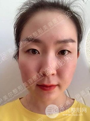 青島伊美爾整形醫(yī)院5s重瞼術(shù)案例日記分享~