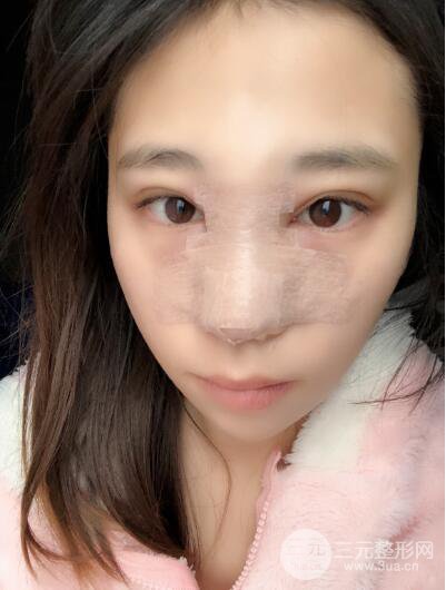 貴陽麗都李觀龍隆鼻整形案例對照圖一個(gè)月恢復(fù)過程分享