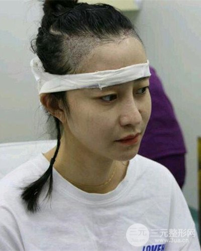 北京雍禾韓巖發(fā)際線種植手術(shù)半年了，分享前后果圖片~