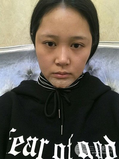 四川友誼李萍醫(yī)生假體墊下巴前后對比果圖片分享~