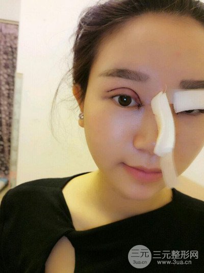 杭州藝之花楊海波全切雙眼皮一個(gè)月的恢復(fù)記錄分享~