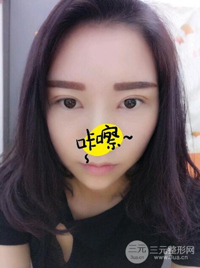 杭州藝之花楊海波全切雙眼皮一個(gè)月的恢復(fù)記錄分享~