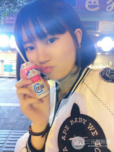 杭州藝之花楊海波全切雙眼皮一個(gè)月的恢復(fù)記錄分享~