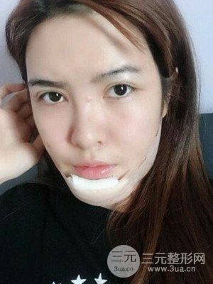 廣州廣美硅膠墊下巴恢復(fù)過程|前后對比照分享
